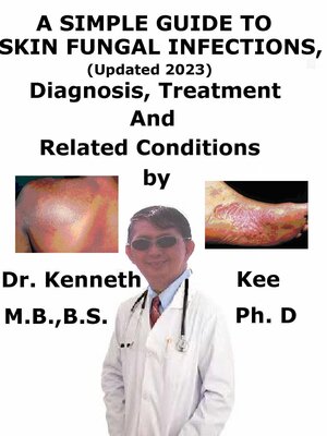cover image of A Simple Guide to Skin Fungal Infections, (Updated 2023) Diagnosis, Treatment and Related Conditions